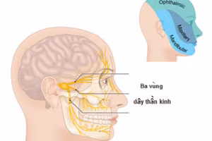 Liệt dây thần kinh số 7.