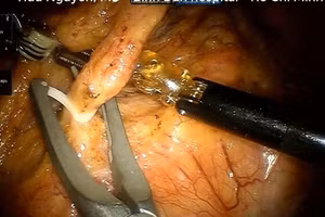 Cánh tay robot thực hiện công đoạn bắt bỏ đoạn trực tràng. Ảnh: NNC.