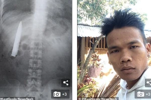 Hay đau ngực khi trời lạnh, đi chụp X-quang thanh niên sốc khi thấy một thứ