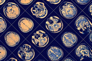 Yếu tố nguy cơ gây tử vong do Covid-19 cao thứ hai 