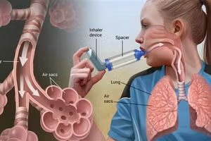 Hen phế quản là bệnh mạn tính.