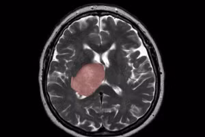 Khối u nguyên bào thần kinh đệm trong não.