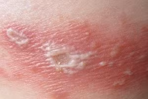 Để phòng ngừa zona thần kinh, bệnh nhân nên đến khám sớm khi bắt đầu có thương tổn ở da để được điều trị thuốc kháng virus trong thời gian vàng. Ảnh minh họa