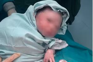 Thai nhi bị dây rốn quấn cổ 2 vòng được cấp cứu thành công tại Bệnh viện Đa khoa Tuyên Quang. Ảnh: BVCC 