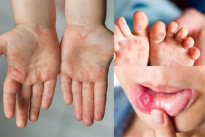 Hai nhóm tác nhân gây bệnh tay chân miệng thường gặp là Coxsackie virus A16 (CA16) và Enterovirus 71 (EV71). Ảnh minh hoạ.