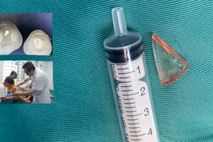 Dị vật được loại bỏ khỏi đầu gối trẻ. Ảnh: BVCC 