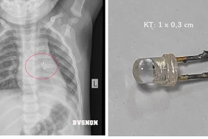 Hình ảnh phim chụp và dị vật được lấy ra khỏi cơ thể bệnh nhân. Ảnh: BVCC