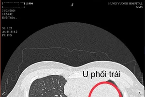 Kết quả chụp cắt lớp vi tính phổi của bệnh nhân, phát hiện khối u thùy trên phổi trái rất to 9x12 cm. Ảnh: BVCC 