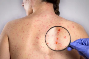 Phát hiện sớm virus rubella sẽ giảm thiểu được nguy cơ dị tật bẩm sinh với thai nhi.