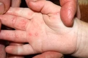 Các nốt phỏng nước do tay chân miệng thường xuất hiện tập trung ở lòng bàn tay, bàn chân và bên trong miệng của trẻ... Ảnh minh hoạ