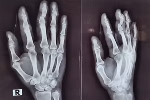 Ảnh chụp X-quang đánh giá các vết thương ở bàn tay của người phụ nữ. Ảnh: BVCC. 