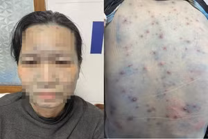 Bệnh nhân mắc thủy đậu khi nhập viện. Ảnh: BVCC