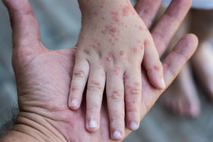 Bệnh rubella có các triệu chứng gồm sốt nhẹ, phát ban và viêm long nhẹ đường hô hấp, nổi hạch vùng cổ, chấm sau tai. Ảnh minh họa