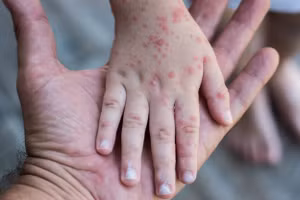 Bệnh rubella có các triệu chứng gồm sốt nhẹ, phát ban và viêm long nhẹ đường hô hấp, nổi hạch vùng cổ, chấm sau tai. Ảnh minh họa