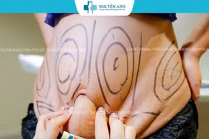 Nhồi máu não sau 45 phút thực hiện hút mỡ tại Viện thẩm mỹ Nguyên Anh. (Ảnh: CMH)