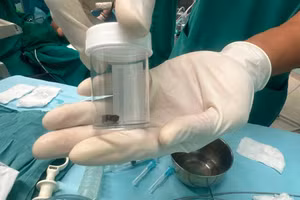 Cuống trái xoài lọt vào đường thở của bé trai 8 tháng tuổi. 