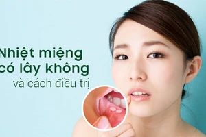 Nhiệt miệng gây xót, đau đớn, khó ăn và khó nói.