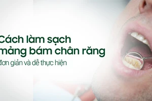 Làm sạch mảng bám chân răng giúp bảo vệ răng tốt hơn.