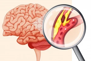 Cục máu đông, nguyên nhân hàng đầu gây tai biến mạch máu não.