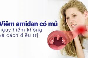 Viêm amidan có mủ cần được nhận biết và điều trị kịp thời.