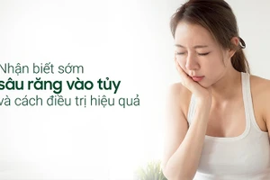 Sâu răng vào tủy có nhiều dấu hiệu nhận biết.