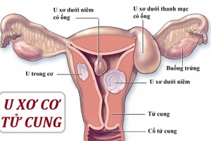 U xơ tử cung là bệnh phụ khoa phổ biến.