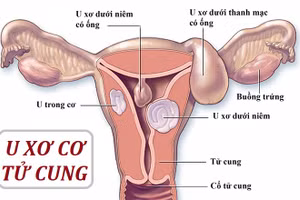 U xơ tử cung là bệnh phụ khoa phổ biến.