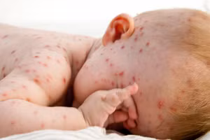 Trẻ em bị thủy đậu.