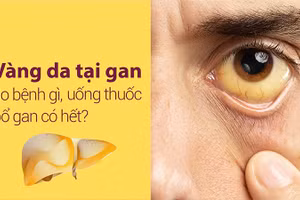 Vàng da tại gan hay gặp ở người trưởng thành.