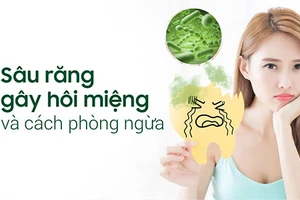 Sâu răng gây hôi miệng không thể cải thiện bằng vệ sinh răng miệng thông thường.