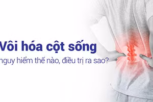 Vôi hóa cột sống gây biến chứng nguy hiểm nếu không được điều trị