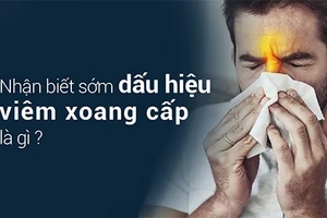 Viêm xoang cấp cần được nhận biết sớm và điều trị ngay.