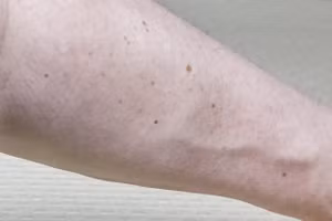 Quá nhiều nốt ruồi ở cánh tay phải có nguy cơ ung thư da.