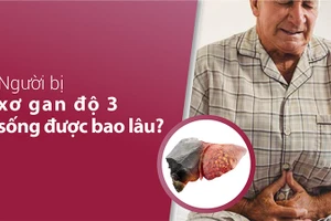 Người bị xơ gan độ 3 sống được bao lâu?