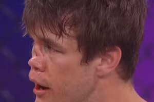 Mũi của võ sĩ MMA biến dạng sau khi lĩnh cú đá từ đối thủ.