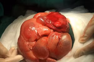 Khối u trong ổ bụng bệnh nhi được lấy ra thành công ( Ảnh: BVCC)