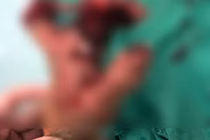 Nạn nhân bị thương dập nát bàn tay do chơi pháo vào dịp Tết (Ảnh: BVCC)