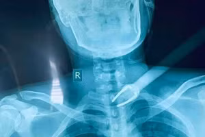 Hình X Quang. (Ảnh: BVCC).