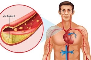 Cholesterol xấu và stress không còn đáng sợ?