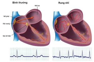 Hình ảnh tai bình thường và tai khi xuất hiện rung nhĩ.