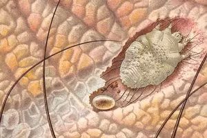 Bọ ve Sarcoptei scabieis gây bệnh ghẻ ở cơ quan sinh dục nam.