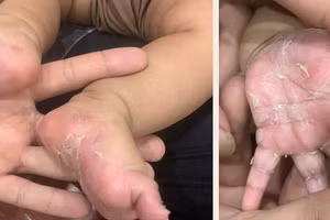 Lòng bàn tay và bàn chân của bé bị tróc vảy do mắc bệnh giang mai 