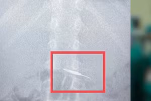 Hình ảnh que chọc sim trong bụng bé trai 7 tuổi.