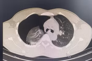 Kết quả Phim CT nhu mô phổi bị xẹp do tràn khí màng phổi. Ảnh: BVCC.