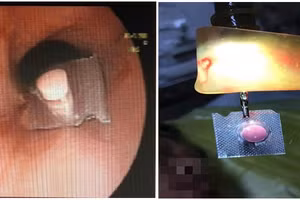 Dị vật nằm ở thực quản bệnh nhân. Ảnh: BVCC.