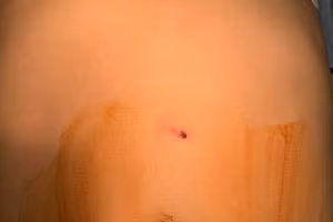 Bệnh nhân tưởng mình chỉ bị thương nhẹ. Ảnh: BVCC.