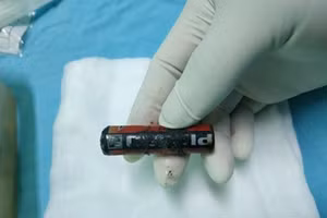 Viên pin bị ăn mòn được lấy ra khỏi âm đạo bé gái. Ảnh: BVCC.