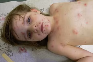 Bị bệnh thủy đậu có kiêng tắm không?