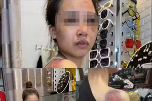 Hình ảnh chị Kiều Thị T.H với nhiều thương tích trên cơ thể. (Ảnh: Internet)