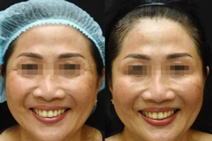 Trước và sau khi điều trị xóa nhăn đuôi mắt bằng botulinum toxin. Ảnh: Bệnh viện Da liễu TPHCM